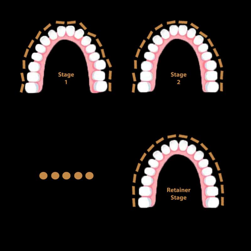 clear aligners stages